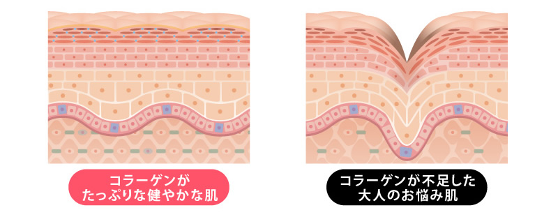 コラーゲンがたっぷりな健やかな肌とコラーゲンが不足した大人のお悩み肌
